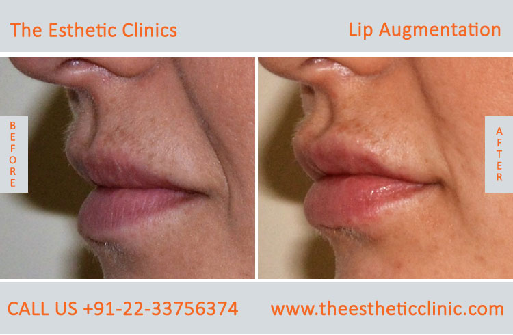 Lip Augmentation, Lip Enlargement, Lip Implant Surgery before after photos in mumbai india (4)